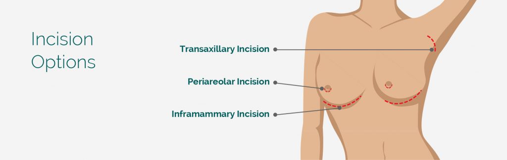 Breast augmentation incision locations