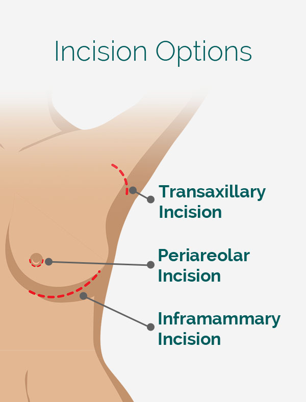 Breast augmentation incision locations