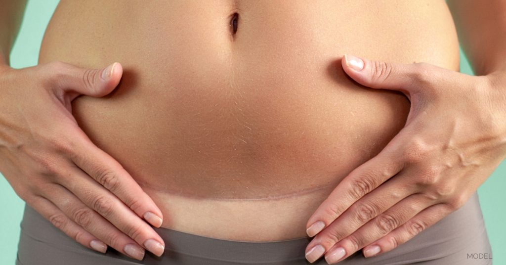woman touching her scar on lower stomach (model)